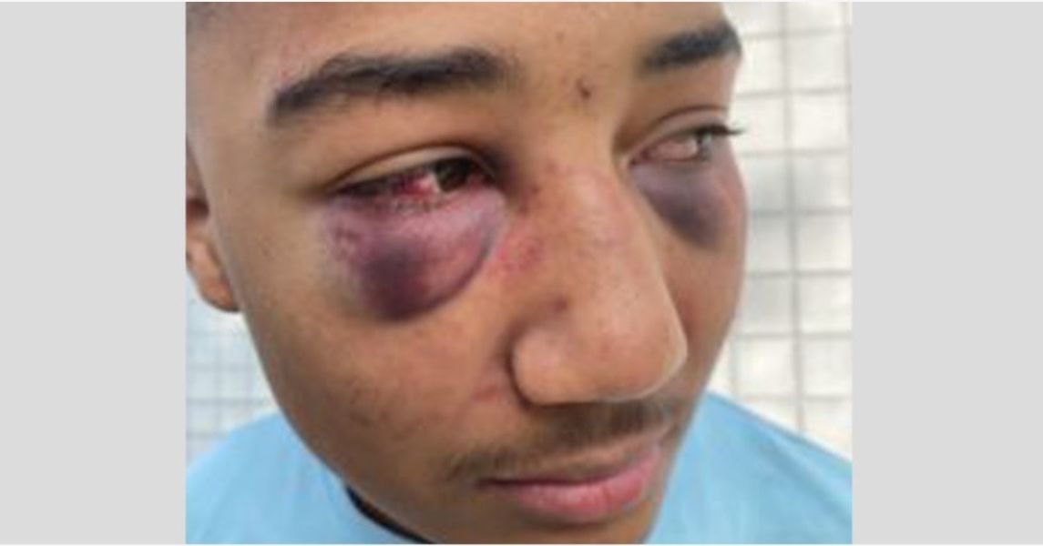 2 ex-californiske betjente tiltalt for at have slået sort teenager, efterladt støvleaftryk i ansigtet